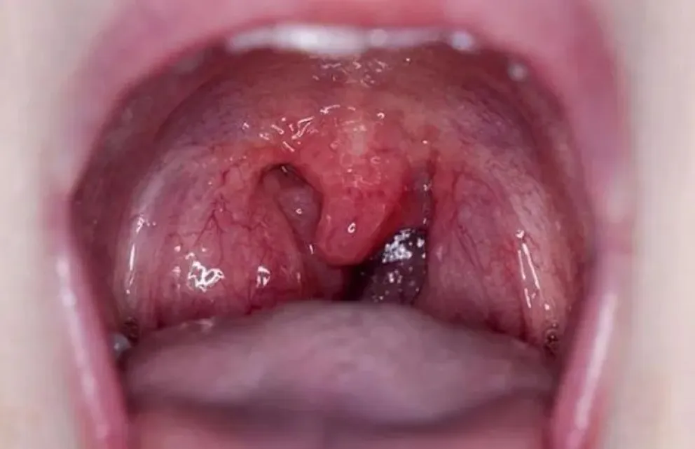 Faringitis aguda: síntomas y medidas preventivas frente a una bacteria amenazante