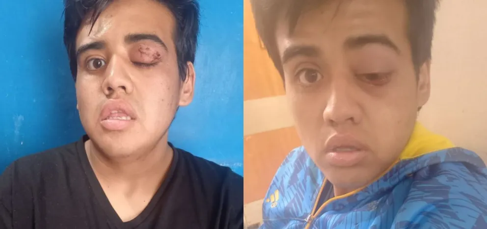 Finalmente el chico atacado en el barrio 827 viviendas no será operado