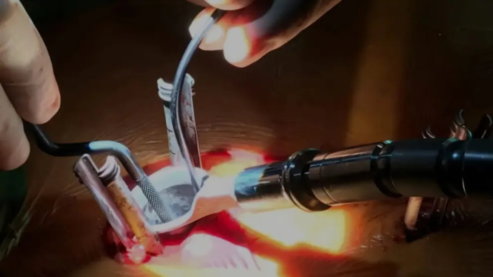 Se utilizan técnicas mínimamente invasivas (MISS, por sus siglas en inglés: Minimally Invasive Spine Surgery).