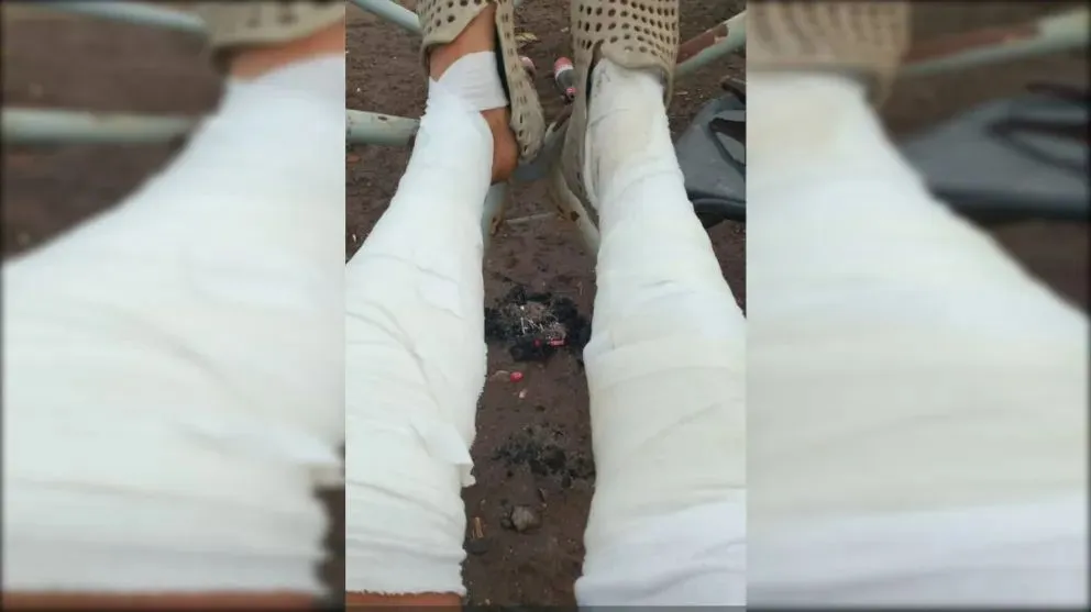 Así han quedado las piernas del hombre que intentó salvar a su familia y sus pertenencias en el fuego.