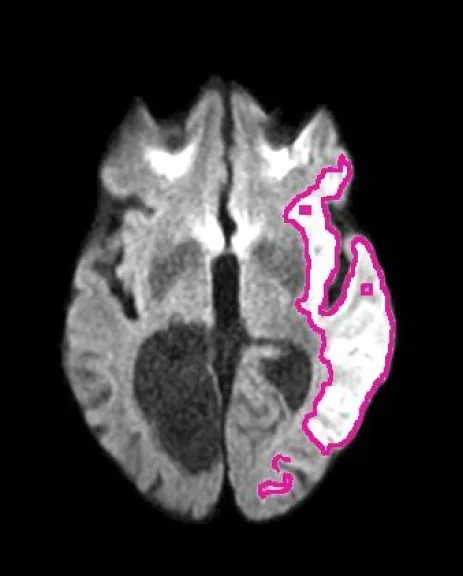 Imagen de resonancia magn&eacute;tica cerebral que muestra, delineada en rosa, el &aacute;rea afectada por un accidente cerebrovascular isqu&eacute;mico, detectada autom&aacute;ticamente por el algoritmo DeepISLES. Foto (Gentileza Ezequiel)