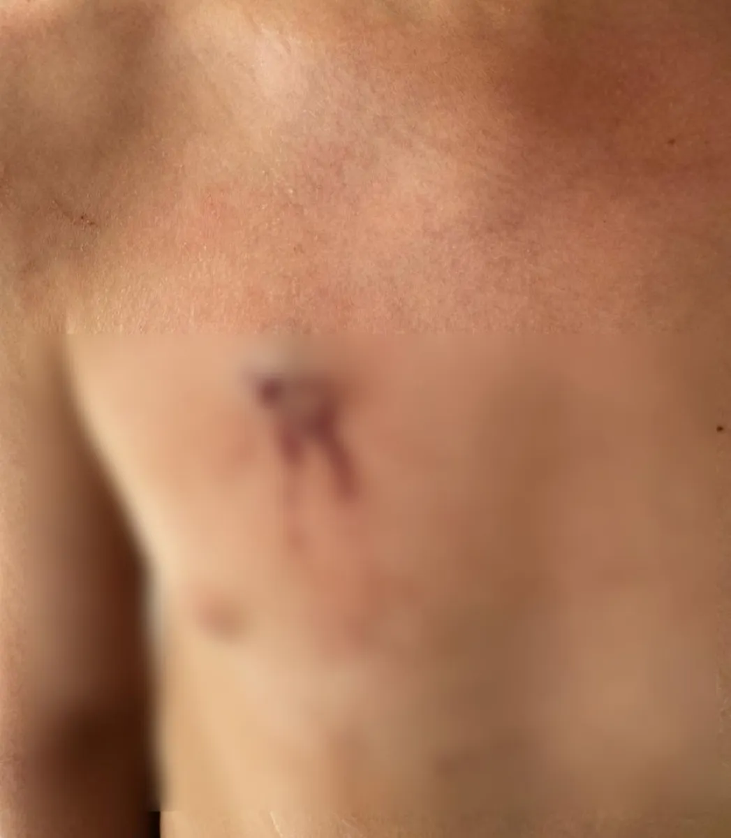 As&iacute; se observan las lesiones en el torso del menor. Foto (gentileza)