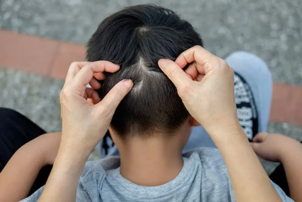 La pediculosis no representan una enfermedad de gravedad. Foto: web