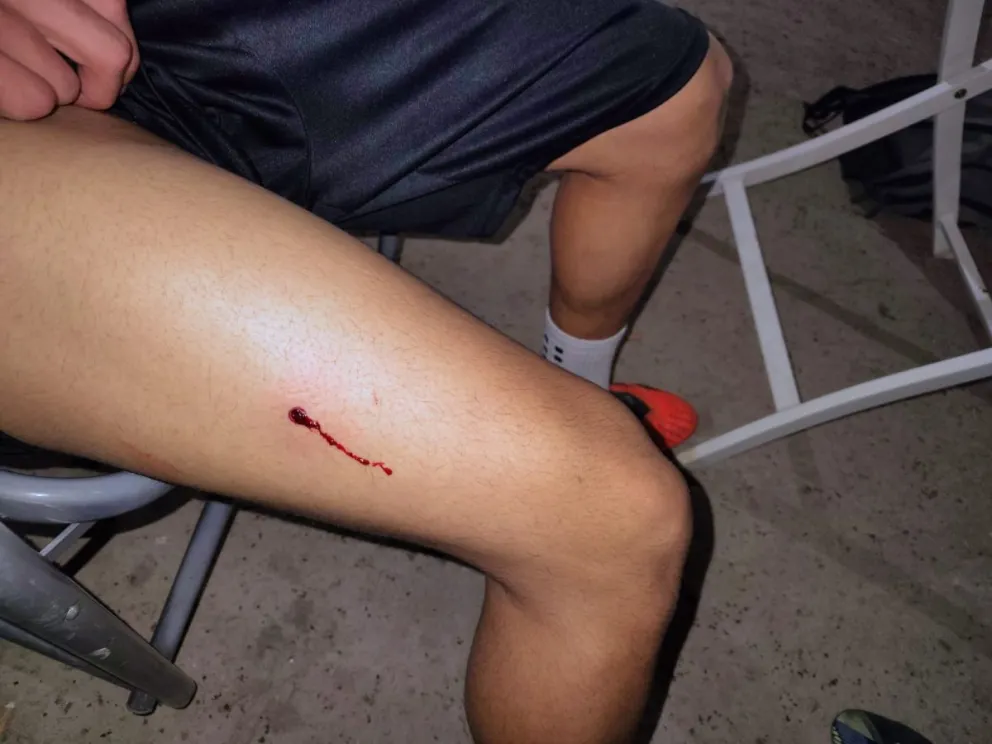 Uno de los jugadores recibió un disparo en una de sus piernas