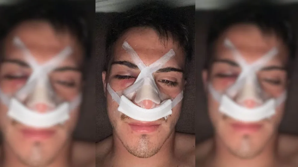 Valentín Salinas sufrió una grave lesión durante un entrenamiento del Deportivo Roca y debió ser operado de urgencia. Foto cortesía